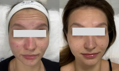 Ботулинотерапия